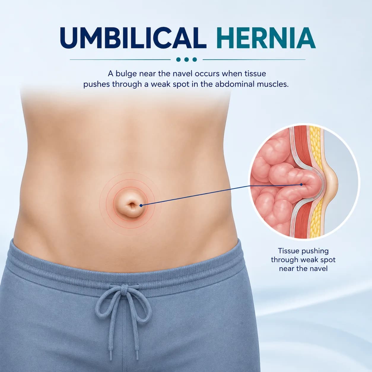 Umbilical Hernia